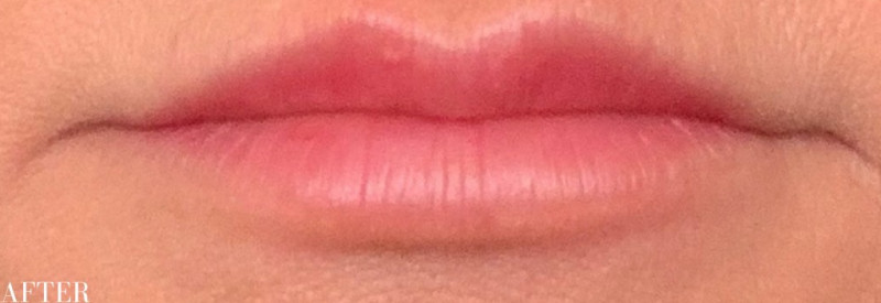 After Image: Restylane Filler - other