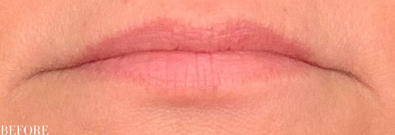 Before Image: Restylane Filler - other
