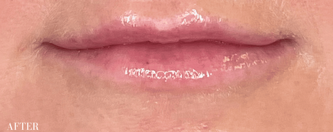 After Image: Restylane Filler - front