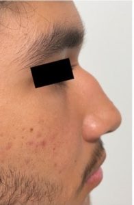 Surgical Rhinoplasty