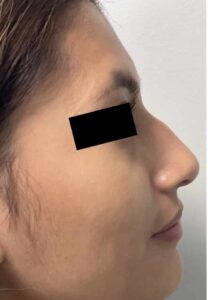 Surgical Rhinoplasty