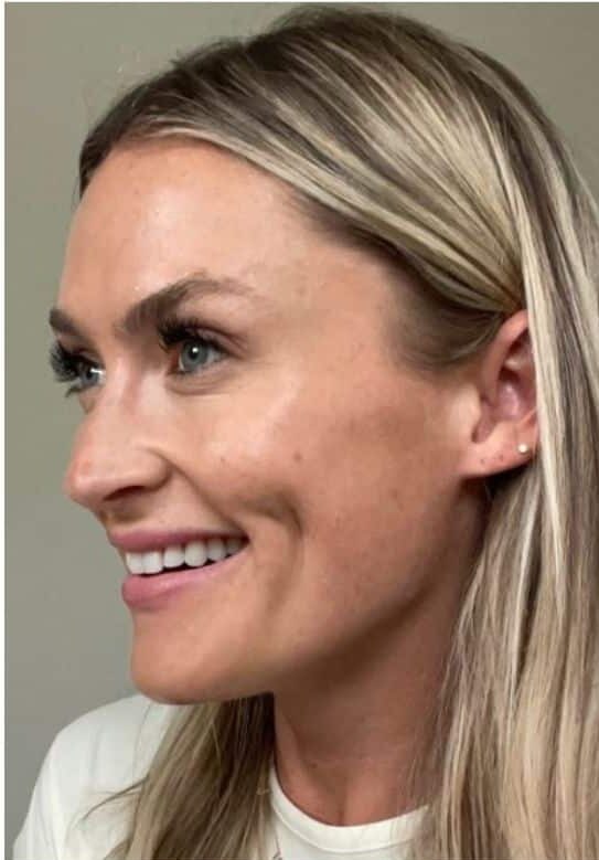 After Image: Xeomin - left-front-oblique