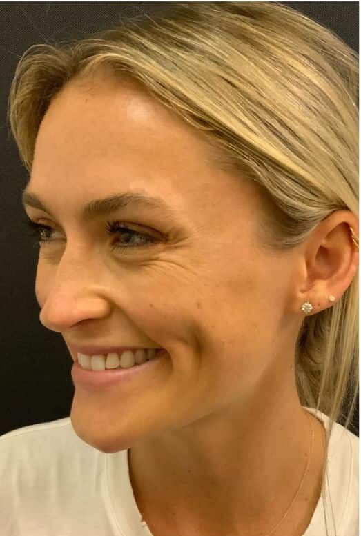Before Image: Xeomin - left-front-oblique