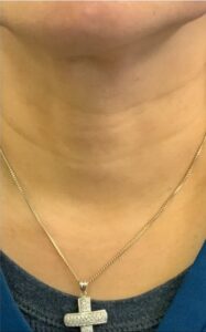 After Image: Xeomin