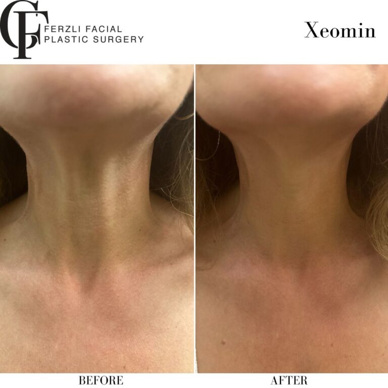 Before and After Image: Xeomin - front