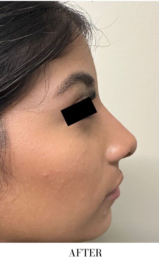 After Image: Rhinoplasty - right-side