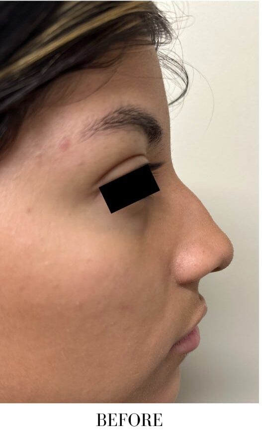 Before Image: Rhinoplasty - right-side