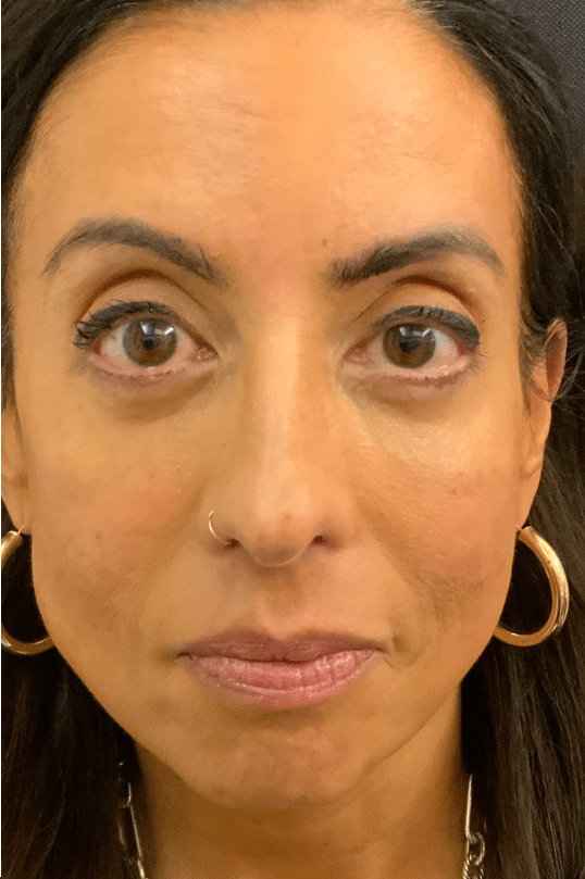 After Image: Blepharoplasty - front