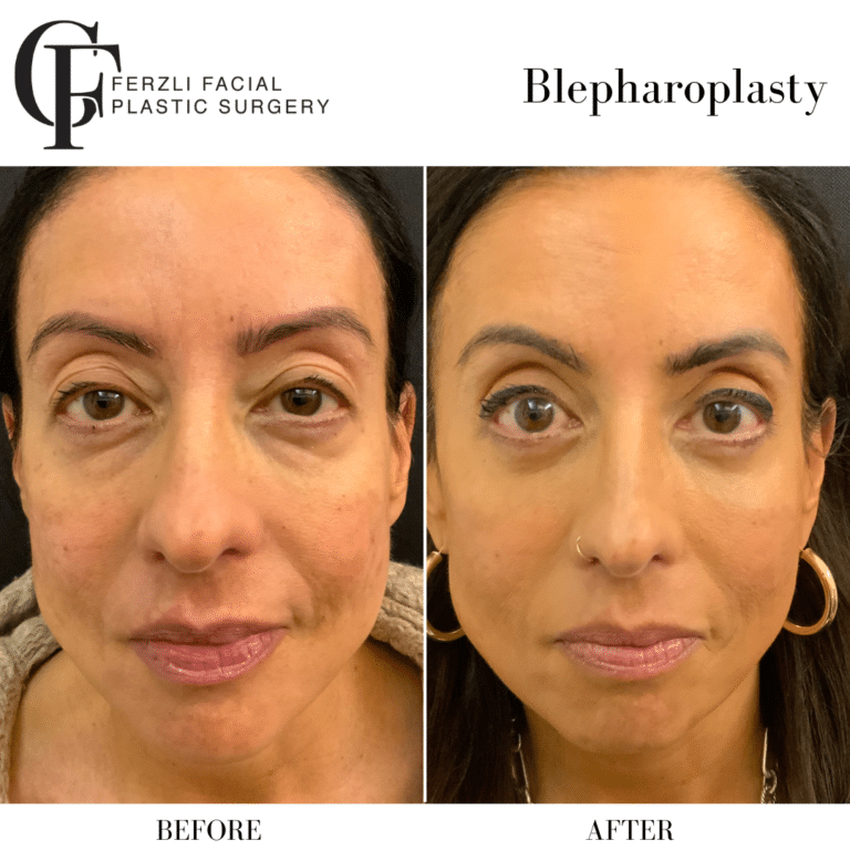 Before Image: Blepharoplasty - front