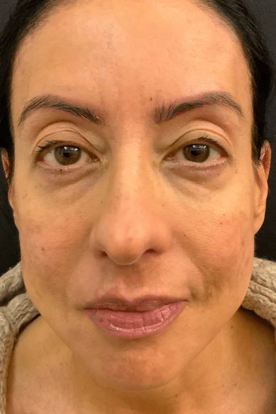 Before Image: Blepharoplasty - front