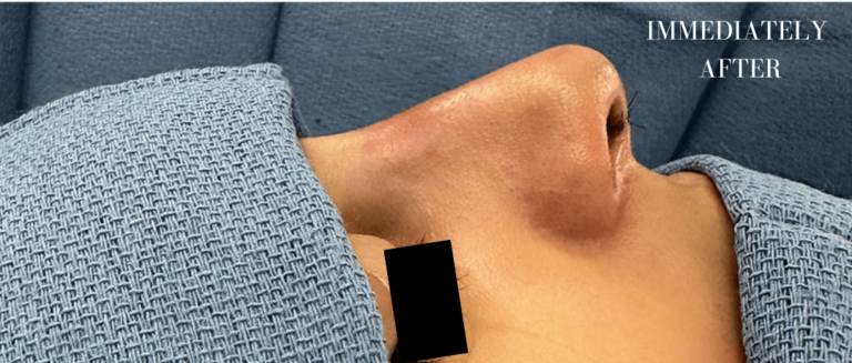 After Image: Rhinoplasty - right-side