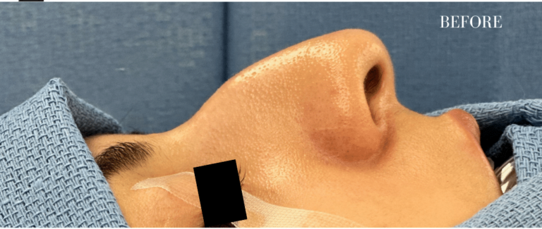 Before Image: Rhinoplasty - right-side
