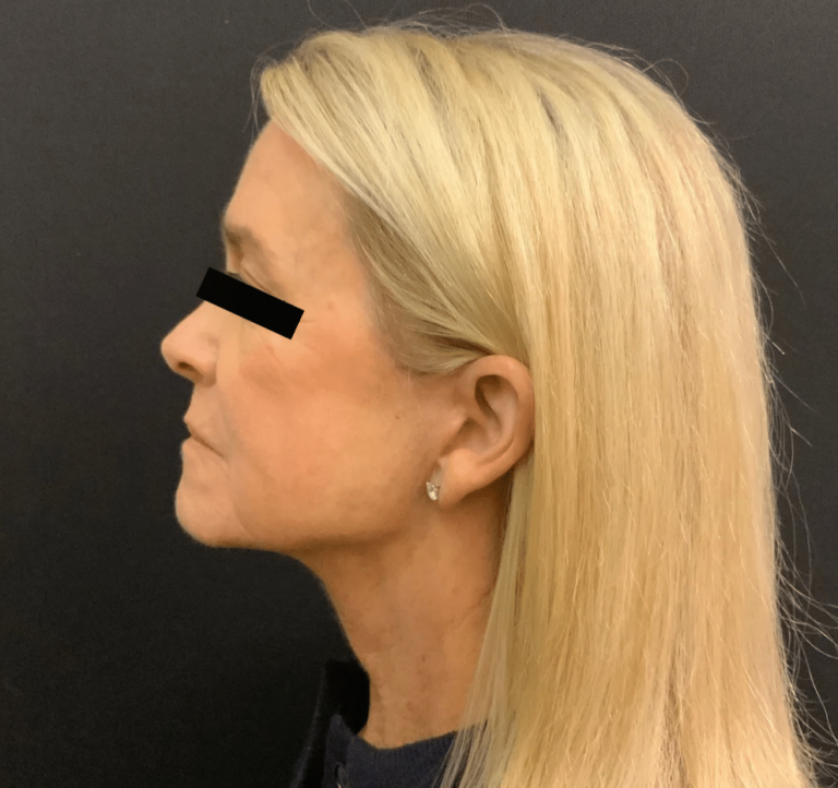 After Image: Facelift, Necklift, Browlift - left-side