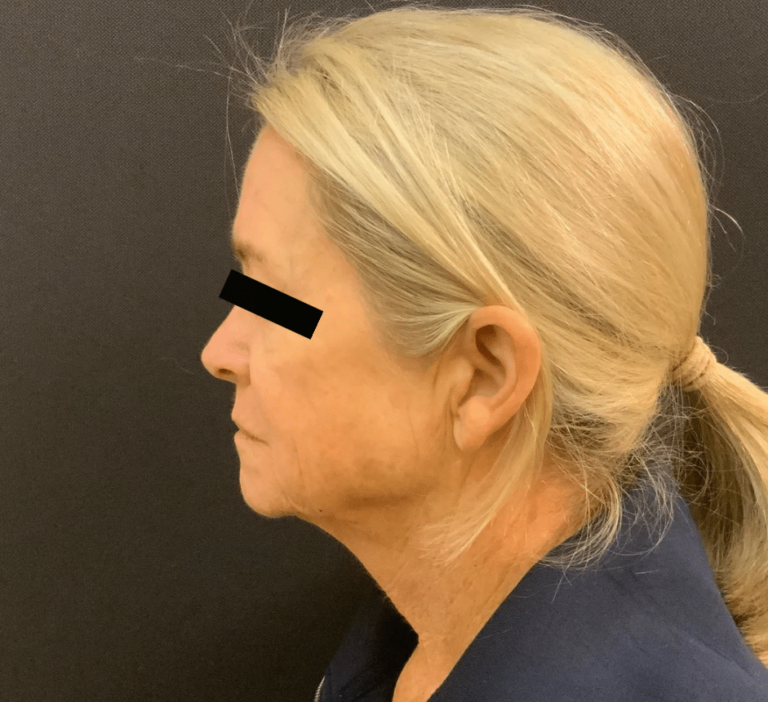 Before Image: Facelift, Necklift, Browlift - left-side