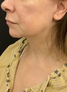 After Image: Facelift and Neck lift