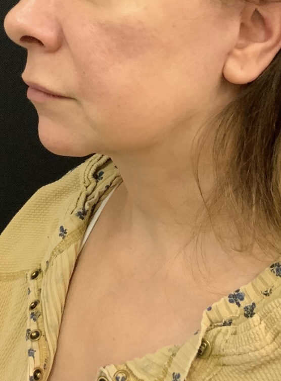 After Image: Facelift and Neck lift - front