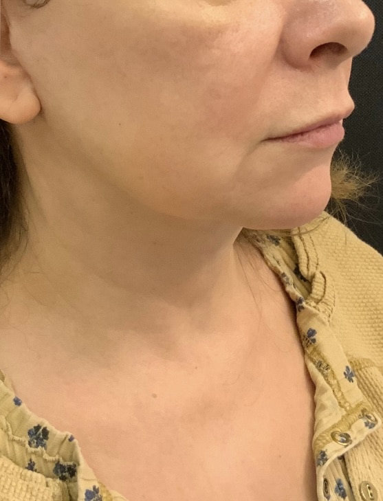 After Image: Facelift and Neck lift - front