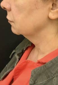 Before Image: Facelift and Neck lift