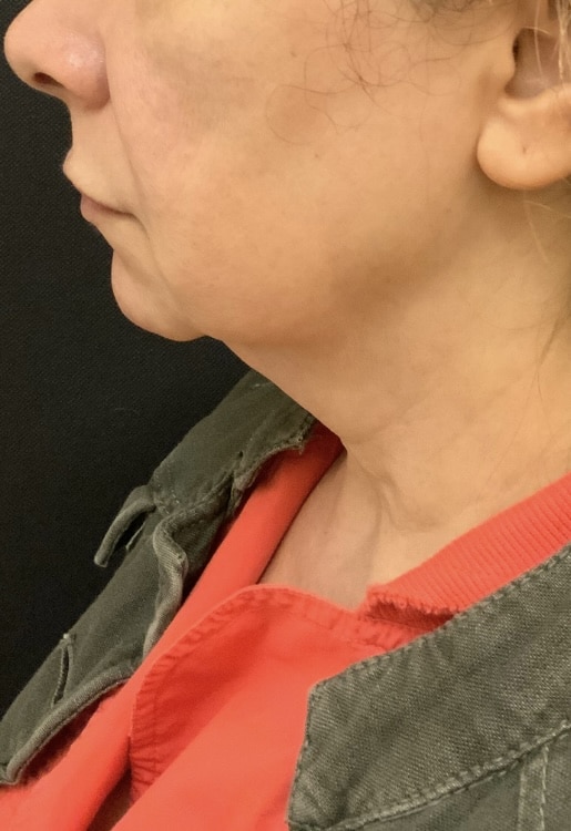Before Image: Facelift and Neck lift - front