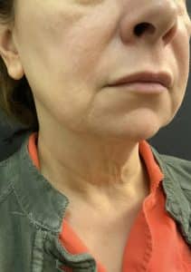 Before Image: Facelift and Neck lift