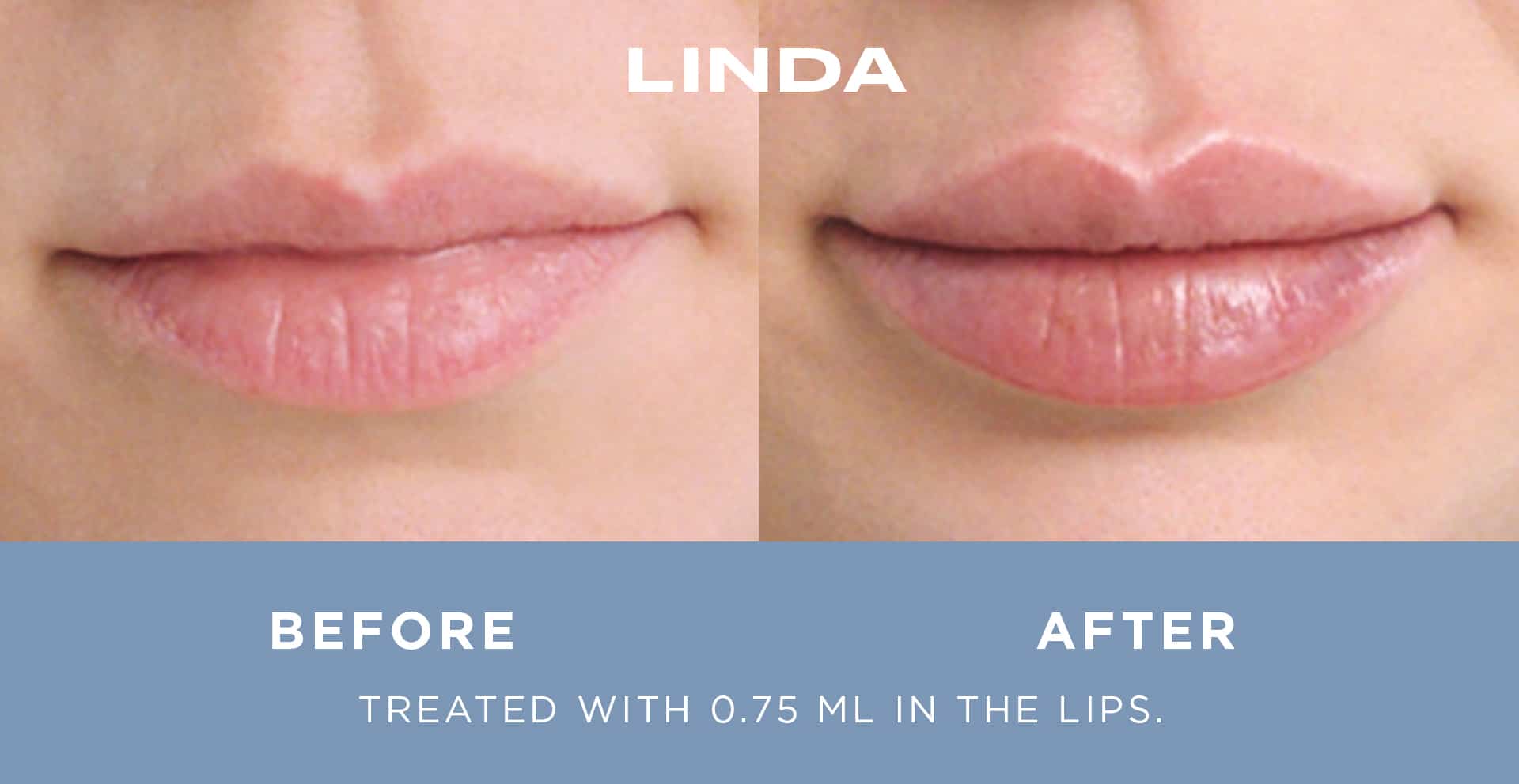Restylane in Upper East Side & NYC 4 linda ba