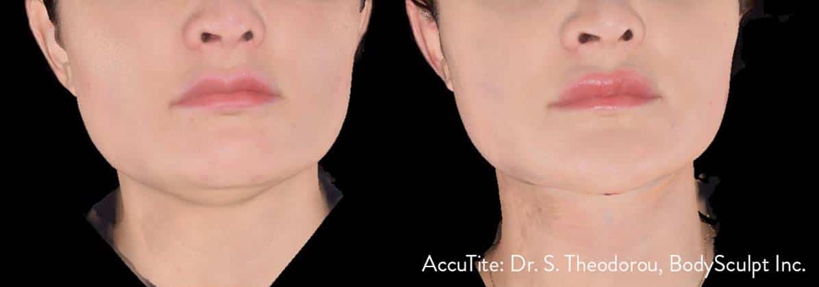 AccuTite in Upper East Side & NYC 4 picture4