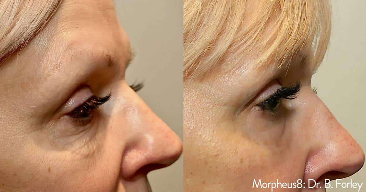 Morpheus8 / Microneedling in Upper East Side & NYC 2 picture6 1