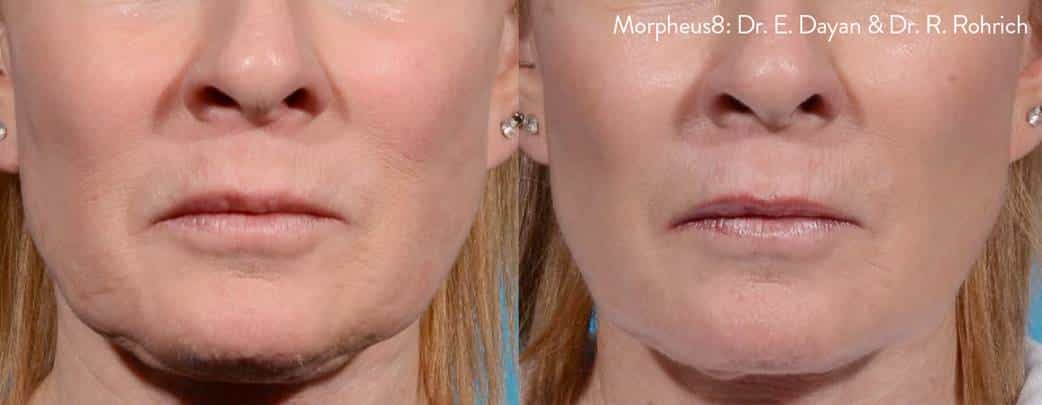 Morpheus8 / Microneedling in Upper East Side & NYC 3 picture9 1