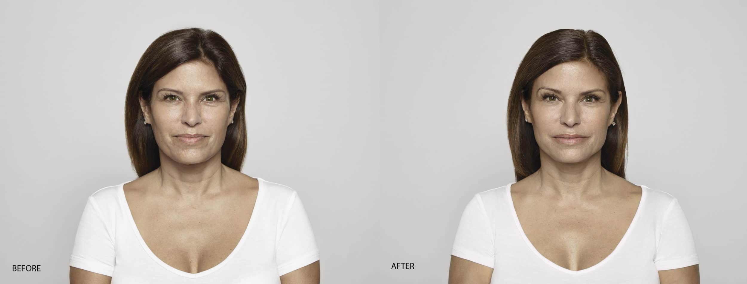 Restylane in Upper East Side & NYC 1 Restylane - Before & After