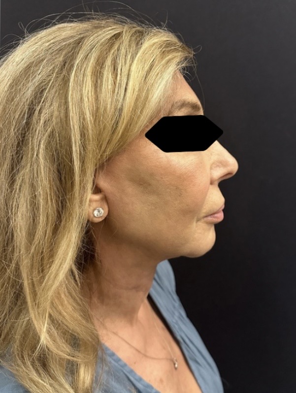 After Image: Facelift and Neck lift - right-side