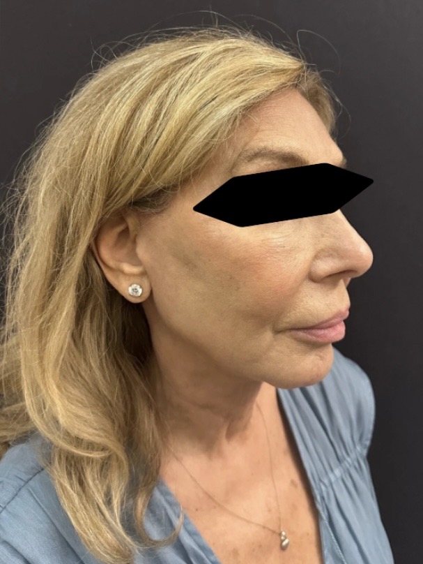 After Image: Facelift and Neck lift - right-front-oblique
