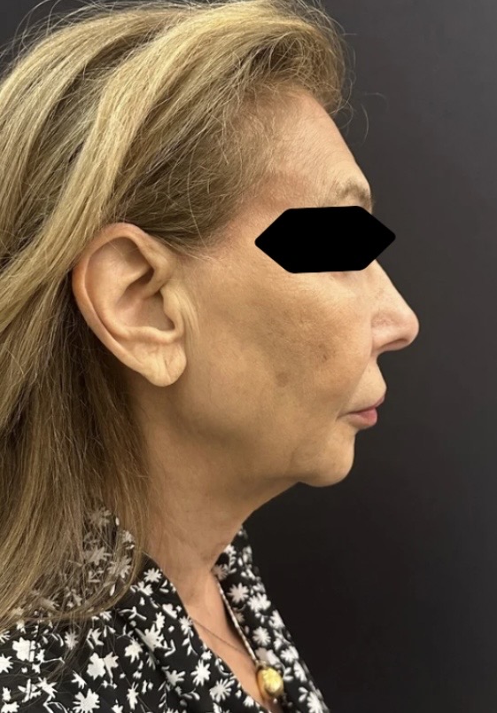 Before Image: Facelift and Neck lift - right-side
