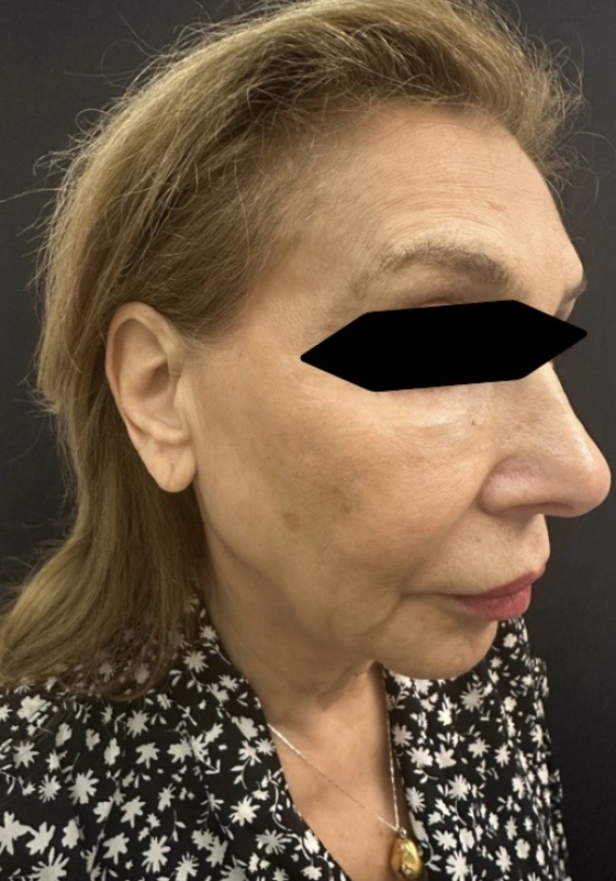 Before Image: Facelift and Neck lift - right-front-oblique