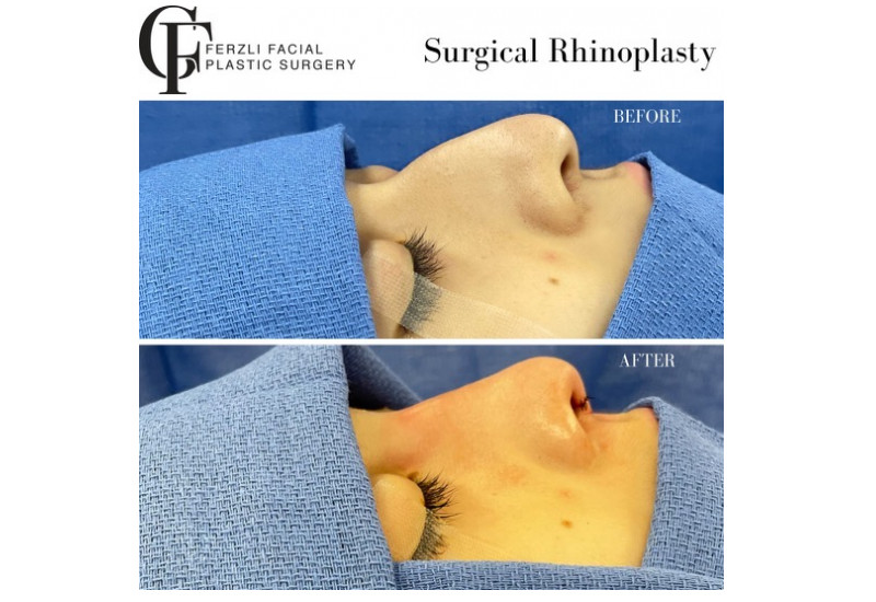 Surgical Rhinoplasty