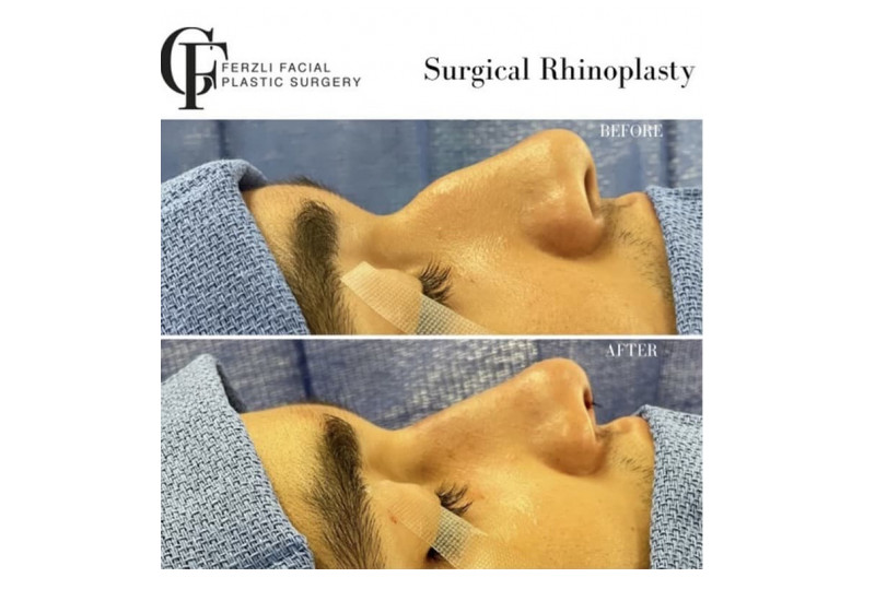 Surgical Rhinoplasty